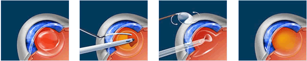 Cataract Surgery Jacksonville FL | Cataract Treatment