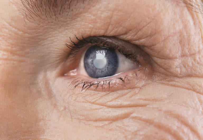 Close Up of An Eye With a Cataract